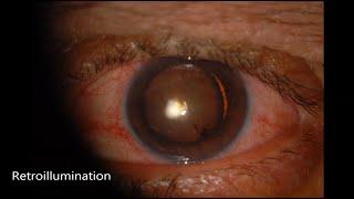 Cataract Surgery with Cionni Ring and Hoffman Pocket for Traumatic Cataract and Zonular Dialysis