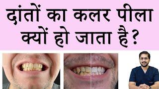 दांतों का कलर पीला होने पर क्या करे  Teeth whitening  दांत सफेद करने  का इलाज