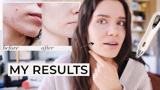 How to Get Rid of Skin Tags Moles Warts  PLASMA IQ vs PLASMA MOLE SKIN TAG REMOVAL PEN REVIEW DEMO