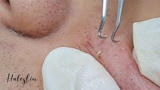 Relaxing and Satisfying CLEAN IT ALL  Halo Skin Hong Kong  Acne and Blackheads 黑頭粉刺