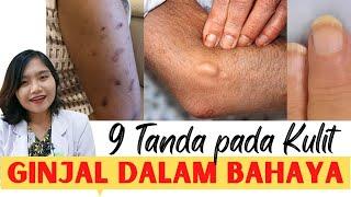 9 EARLY SYMPTOMS OF THE SKIN WHEN THE KIDNEY IS DAMAGED