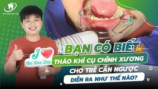 Kết Thúc Giai Đoạn Chỉnh Khớp Cắn Ngược Móm Cho Trẻ Nhỏ