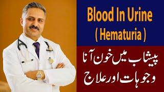 Blood in Urine  Hematuria  Causes & Treatment.