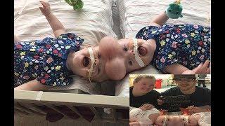 The best 1st birthday present ever  Infant girls conjoined at the Head Successfully Separated