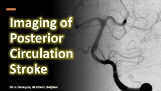 Imaging of Posterior Circulation Stroke - Basilar artery thrombosis and beyond improved sound