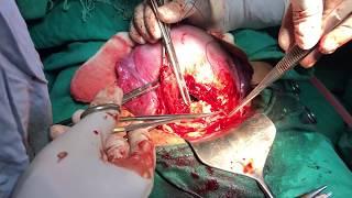 Cesarean delivery  c-section  Surgical technique - HD Video