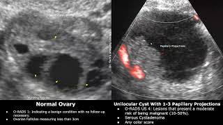 Ovarian-Adnexal Reporting and Data System Ultrasound O-RADS US  Classification Of Ovarian Lesions