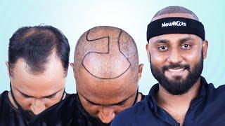 Grade 5 Vertex Baldness Surgery My Experience   Hair Transplant in Bangladesh  New Roots