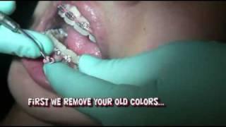 Your braces appointments adjustments not tightening