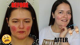 HOW I BEAT ROSACEA  My Skincare Routine 2017  Live Love Vicky