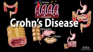 Crohns Disease Pathophysiology Symptoms Risk factors Diagnosis and Treatments Animation.