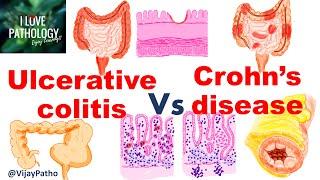 Ulcerative colitis Vs Crohns disease  #inflammatoryboweldisease