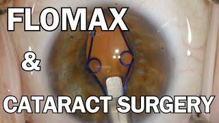 FLOMAX & Cataract Surgery  My Approach