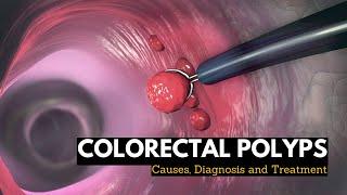 Colorectal Polyps Causes Signs and Symptoms Diagnosis and Treatment.