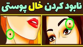 از بین بردن خال های صورت  برداشتن خال صورت  برداشتن خال گوشتی