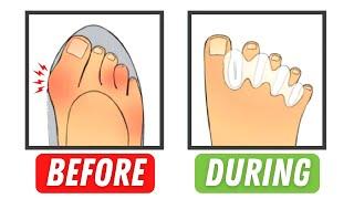 Why Toe Spacers  Can you avoid EXPENSIVE surgery?