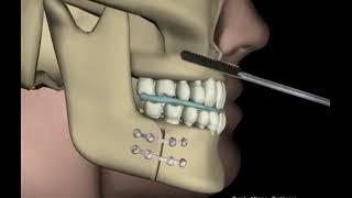 جراحی زیبایی فک و چانه - عمل زاویه سازی صورت  فک بالا و فک پایین