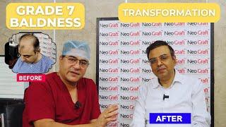 Grade 7 Baldness  Hair Transformation Journey  Dr Nav Vikram - Hair transplant In Chandigarh.