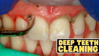 Teeth Cleaning vs Deep Cleaning  Dentist Reviews How Teeth Are Cleaned