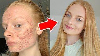 HOW I COVER MY ACNE grwm + tutorial