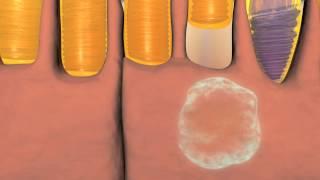 Animation of Wet and Dry Macular Degeneration