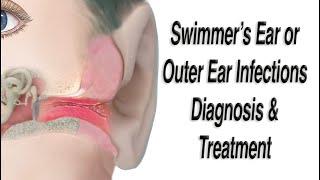 Outer Ear Infections aka Swimmers Ear Infections Acute Otitis Externa Diagnosis and Treatment