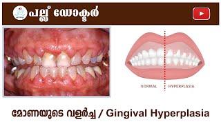 മോണയുടെ വളർച്ച   Understanding Gingival Hyperplasia Causes Symptoms and Treatment Options