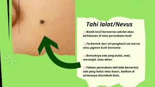 Info seputar tahi lalat by dr. Sri esa ilona Sp.DV