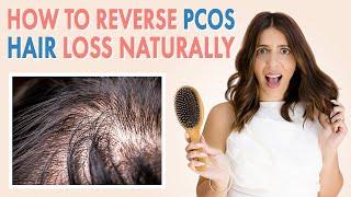 PCOS Hair Loss Treatment  Causes + Products + Natural Remedies TO GROW BACK YOUR HAIR