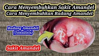 CARA MENYEMBUHKAN SAKIT AMANDEL - CARA MENYEMBUHKAN RADANG AMANDEL  TONSILITIS