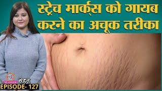 Skin पर पड़े Stretch Marks जा नहीं रहे तो Doctors की ये सलाह मानें    Sehat ep 127