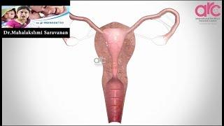 Adhesions Uterus Fallopian tubes Ovaries Genital & Reproductive tract -ARC Fertility Hospitals India