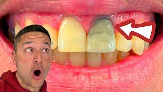 How to Internal BLEACH a root canaled tooth.