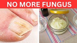 Garlic Paste The Secret to Banishing Toenail Fungus for Good