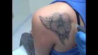 How To Remove A Tattoo