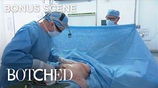 Botched Doc Performs Liposuction Surgery  E