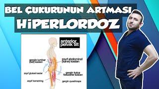 BEL ÇUKURUNUN ARTMASI ARTMIŞ-LORDOZ EGZERSİZ  KESİN ÇÖZÜM