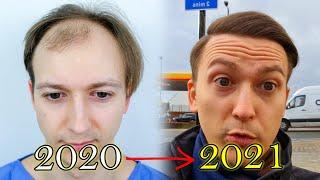 FUE Hair Transplant Growth Timeline  Before & After