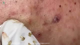 Big Cystic Acne Blackheads Extraction Blackheads & Milia Whiteheads Removal Pimple Popping