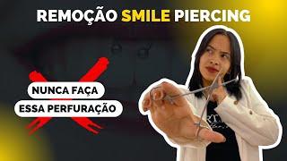 Remoção Smile Piercing - Nunca faça essa perfuração