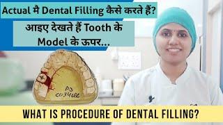 What is actual procedure of Dental Filling? Tooth Filling कैसे करते हैं?