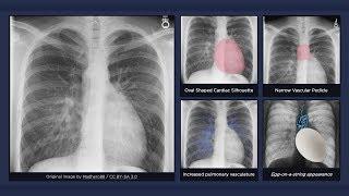 Transposition of the Great Arteries Explanation of Chest X-ray Findings Egg-on-a-string