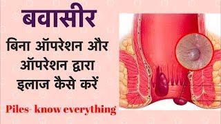 बवासीर - बिना ऑपरेशन और ऑपरेशन द्वारा इलाज कैसे करें  Piles  Hemorrhoids