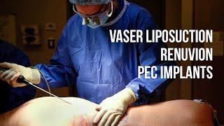 Pectoral Implants VASER Liposuction & Renuvion Scar Revision - Dr. Ruff  West End Plastic Surgery