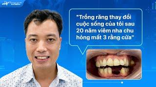 Sau Khi Sử Dụng Răng Implant Tôi Quên Luôn Mình Đã Trồng Răng Giả