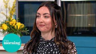 The Truth About Adult Acne Expert Advice for Clear Skin  This Morning