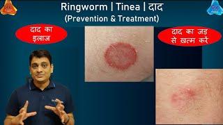 Fungal Ringworm - Complete Treatment  दाद का इलाज  Tinea  Dermatophytosis By Dr. Puspendra
