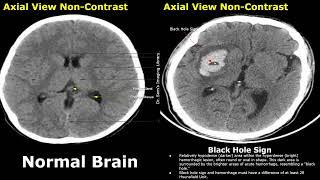 CT Scan Brain Normal Vs Hemorrhagic Stroke Images  Swirl Black Hole Blend Spot & Island Signs