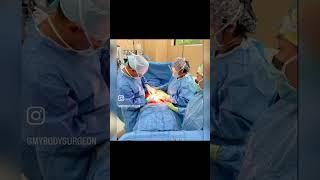 Mini Tummy Tuck - Abdominal Etching -  Breast Augmentation With Silicone Breast Implants
