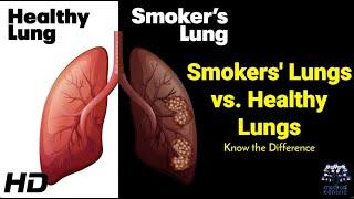 Smokers vs. Non-Smokers A Lung Comparison You Need to See